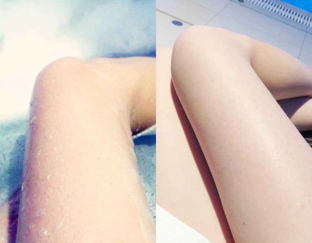 Jak uniknąć krostek po goleniu: skuteczne sposoby na gładką skórę