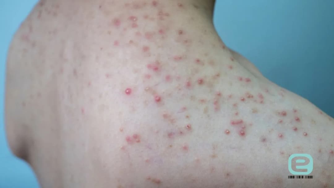 Zapalenie mieszków włosowych po goleniu: leczenie, domowe sposoby i profilaktyka